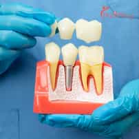 Capitalizing on EU Cross-Border Care: German Medical Tourists Drive Record Demand for Premium Dental Crowns in Croatia